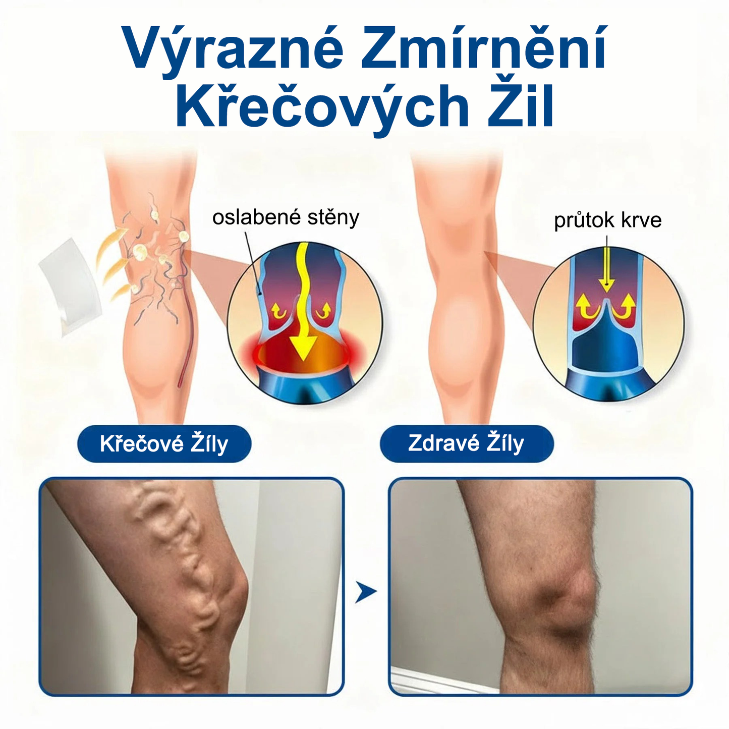 ✅FLORISMA® Klinická mikrojehličková náplast s diosminem a hesperidinem🌿 – zaměřená na křečové a metličkové žilky, pomáhá zmírnit pocit těžkých a unavených nohou