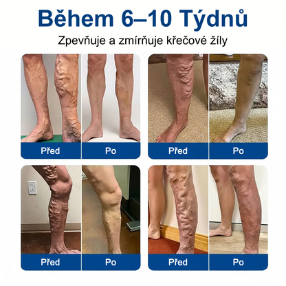 ✅FLORISMA® Klinická mikrojehličková náplast s diosminem a hesperidinem🌿 – zaměřená na křečové a metličkové žilky, pomáhá zmírnit pocit těžkých a unavených nohou