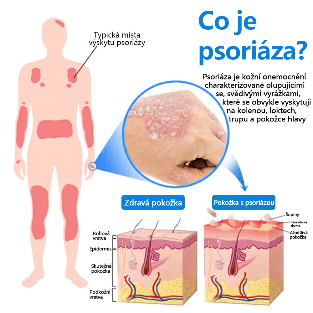 Zvoevo® Magnesium bylinný sprej ⚕️ Certifikace MHRA – úleva při psoriáze, ekzému, intimních bakteriálních infekcích, akné a tmavých skvrnách