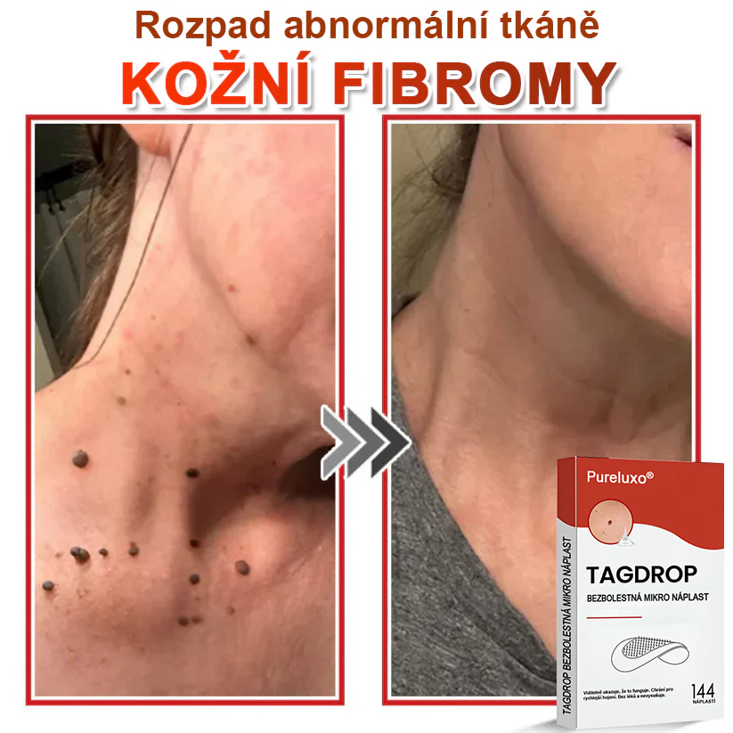 🇨🇿Pureluxo® Mikrovpichová botanická náplast na odstranění kožních výrůstků 🇨🇿 Vyrobeno v Česká republika