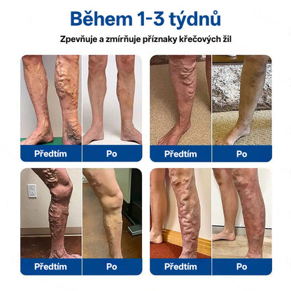 🎁GFOUK® VeinTarget Microneedle Patch |⚡ Okamžitá úleva, dlouhodobé výsledky