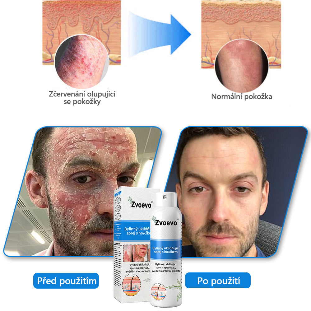 Zvoevo® Magnesium bylinný sprej ⚕️ Certifikace MHRA – úleva při psoriáze, ekzému, intimních bakteriálních infekcích, akné a tmavých skvrnách
