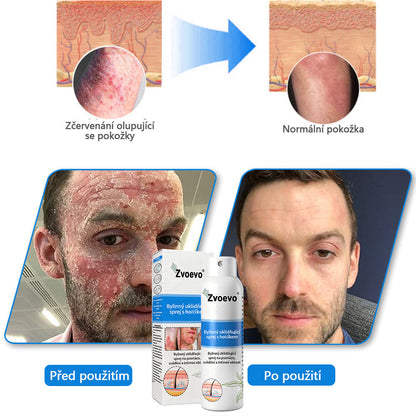 Zvoevo® Magnesium bylinný sprej ⚕️ Certifikace MHRA – úleva při psoriáze, ekzému, intimních bakteriálních infekcích, akné a tmavých skvrnách