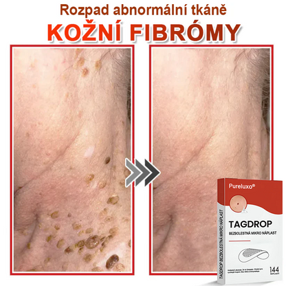 🇨🇿Pureluxo® Mikrovpichová botanická náplast na odstranění kožních výrůstků 🇨🇿 Vyrobeno v Česká republika