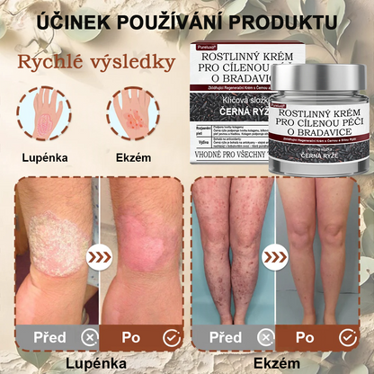 ✅ Pureluxo® Fekete Rizses Bőrregeneráló Krém 👨‍⚕️ (Szemölcsök, bőrkinövések, foltok és hiperpigmentáció kezelésére)✅✅